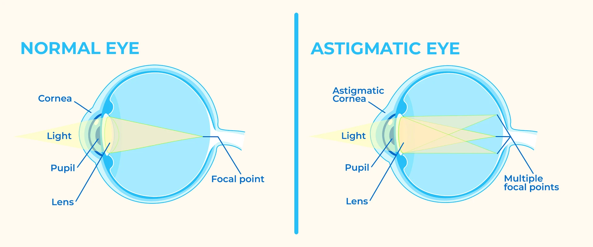 normal vs astigmatism christmas lights