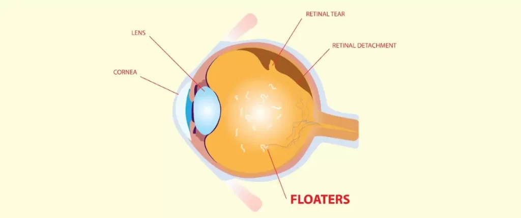 what are floaters