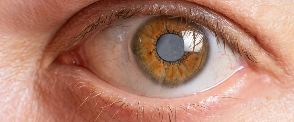Eye Cataract - Tempory Vision Loss